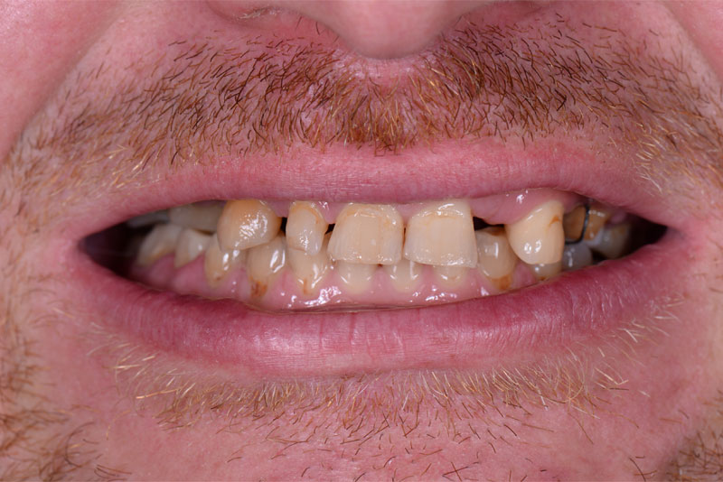 before dental procedure